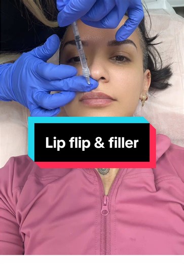Understanding the Lip Flip Procedure