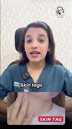 Skin Tags VS Moles – How to Tell the Difference!