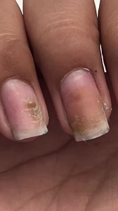 Green Nail Syndrome/the Greenies begin small on the nail, but if left untreated will burrow deeper and ruin more layers of the natural nail. We want to treat any lifting, white or discoloured areas right away to prevent this from happening. #nailcareereducation #NailTutorial #nailtechlife #nailcare #diynails #nailtech #naileducation | Nail Career Education