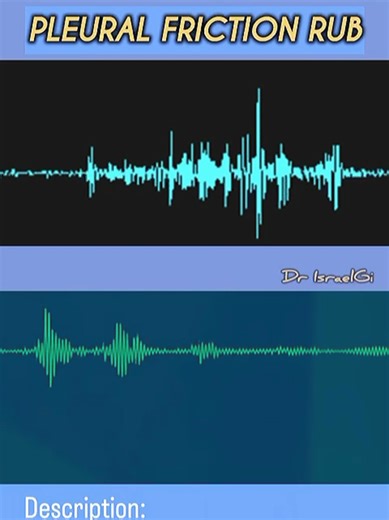 #lungsounds A pleural friction rub is an audible respiratory sound, often likened to the creaking of leather or the squeaking of a shoe on wet surfaces, that serves as a distinctive clinical sign indicative of pleural inflammation and is commonly associated with conditions such as pleurisy, pneumonia, a pulmonary embolism,….