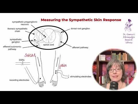 Abnormal sympathetic skin response in fibromyalgia