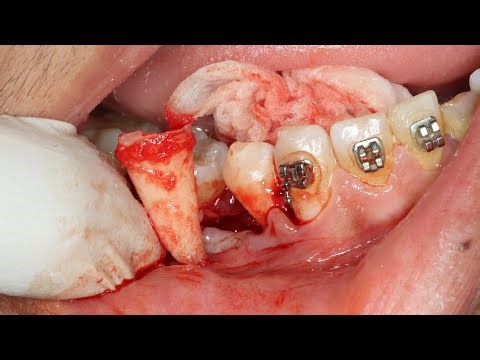 Extracting lower second premolar full case details