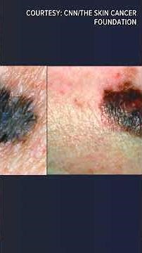 Skin Cancer Awareness Month