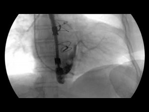 Coronary sinus catheter Fluoroscopy Correct placement