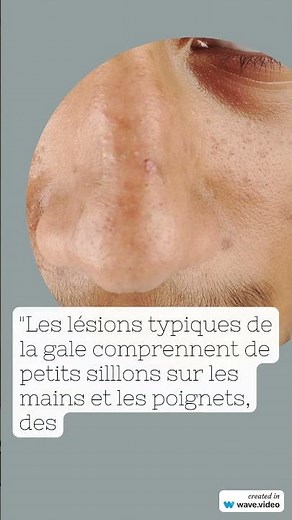 BOUTON DE LA GALE comment sont les boutons et sillons de la gale