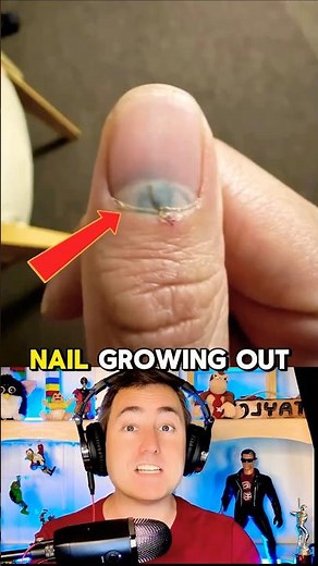 Bruised Nail Growing Out
