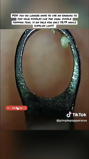 Stop using earrings to pop pimples! Upgrade your skincare game with this viral tool for just $2.99. Limited time only‼️ #pimplepopping #SkincareMustHave #skincaretips #skincaretools #tiktokshop