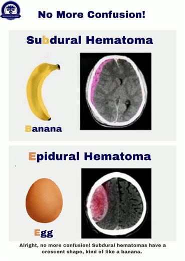 Medicine Master Academy | USMLE | Subdural hematomas, caused by tearing of bridging veins, spread slowly between the dura and the brain, forming a crescent or banana shape.... | Instagram