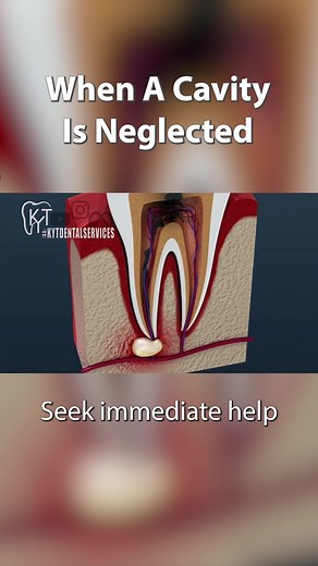 Spotlight on Dental Abscess: A Must-Know Guide! 🦷🔍 Ever wondered what a dental abscess is and how to deal with it? Let's dive into this dental concern, from causes to symptoms, and steps to take. Your oral health matters, and knowledge is key! 💡✨ #DentalAbscess #OralHealth #DentalCare #AbscessAwareness #DentalEmergency #ToothPain #DentalKnowledge #OralCare #DentalAwareness #GumSwelling #ToothInfection #EmergencyDentistry #DentalPain #OralHealthMatters #AbscessTreatment #OralInfection #DentalI