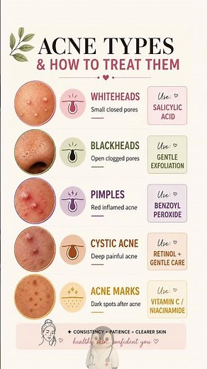 Acne Types Explained How to Treat Whiteheads, Blackheads, Pimples & More