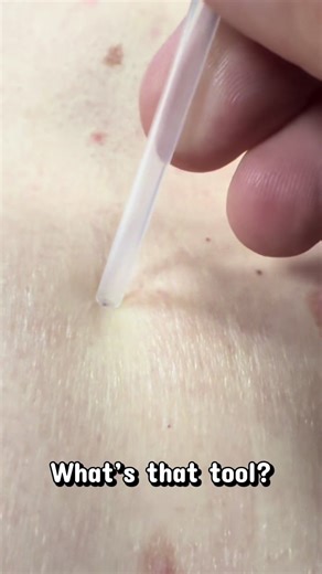 Literally no pain felt extracting this blackhead, ask a friend to help you out with some simple pimples! #skincare #pimple #blackhead #oddlysatisfying #simplepimple