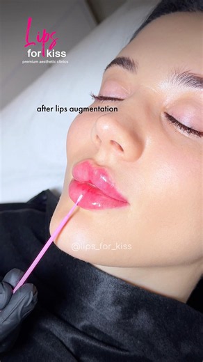 RUSSIAN LIPS BALANCE 🔥 #filler #lipsaugmentation #transformation