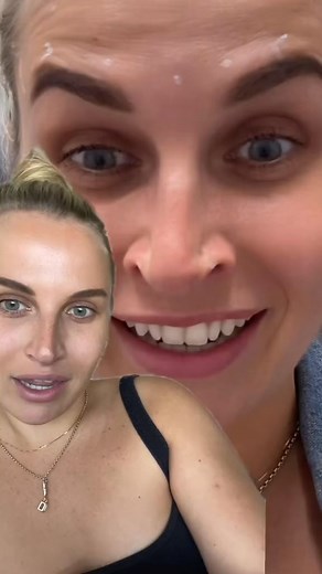 Nasal botox results after 24 hours! Follow along for daily updates! #nasalbotox #botox #beauty #resu | Scary Stories from Victor