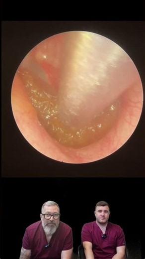 BLOOD VESSEL VISIBLE ON THE EARDRUM — MEP188