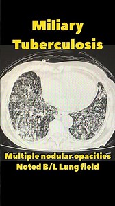 Miliary tuberculosis | CTscan Lung window | Radiology #radiology #tuberculosis #pulmonology