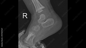 Precision Lateral X-ray of Pediatric Ankle Joint: Diagnostic Insights into Ankle Fractures and Skeletal Development