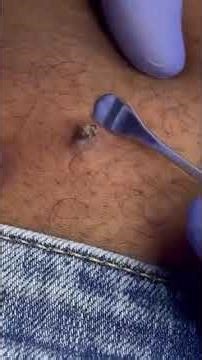 Removing large blackheads and pimples from face new 2026 #98