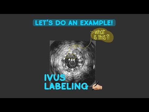 IVUS Example One: In Stent Thrombosis & Undersizing