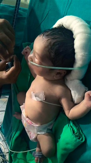 92K views · 1.7K reactions | NG Tube/Feeding Tube Insertion In A Newborn #newbornbaby #newborn #shorts #feeding #newborn #nicucare #trending #baby | Gautam Ashish | Facebook