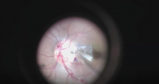 Surgical Technique for Pediatric Optic Disc Pit Maculopathy - Eyetube