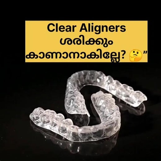Will people see if I wear clear aligners? 🤔#reelsvideo #dental #shorts #malayalam #reels