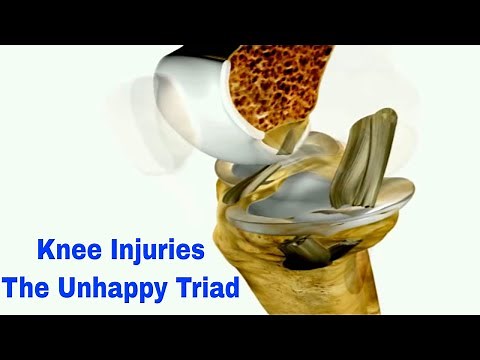 Knee Injury Nightmare: Decoding the Unhappy Triad (ACL, MCL, & Meniscus) #KneeInjury #UnhappyTriad