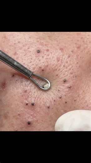 Relax Every Day 1 Spa #acne​ #blackheads​#whiteheads​ #Treatments​ #pimple​ #SacDepSpa​