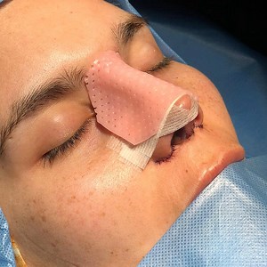 [Hot Item] Ent Medical Equipment Nose Surgery Rhinoplasty Rehabilitation External Nasal Thermoplastic Splint