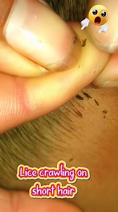 Lice crawling on short hair #licetreatment #headlice #lice #usareels #usa #asmr | Leny Marlina