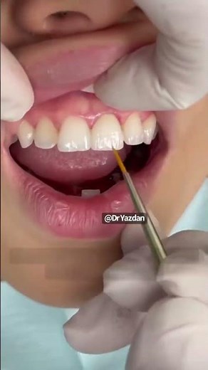 Porcelain crowns front teeth | Dr. Yazdan | porcelain crown process | Newport Beach Orange County