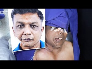 Advanced Cancer Reconstruction Technique | Full Operation Video