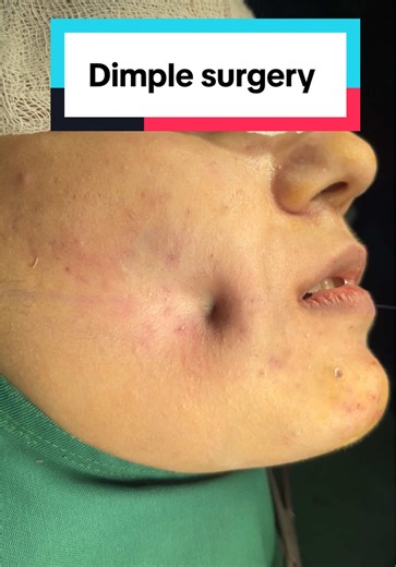 Dimple Surgery: Enhance Your Smile Naturally