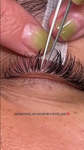 Removing an Ingrown eyelash #acelifelashes #AcelifeBeauty#cashmerelashes