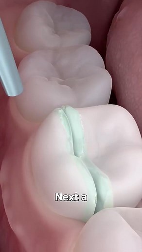 How Dentists Repair A Split Tooth 😬 | Facto Hub