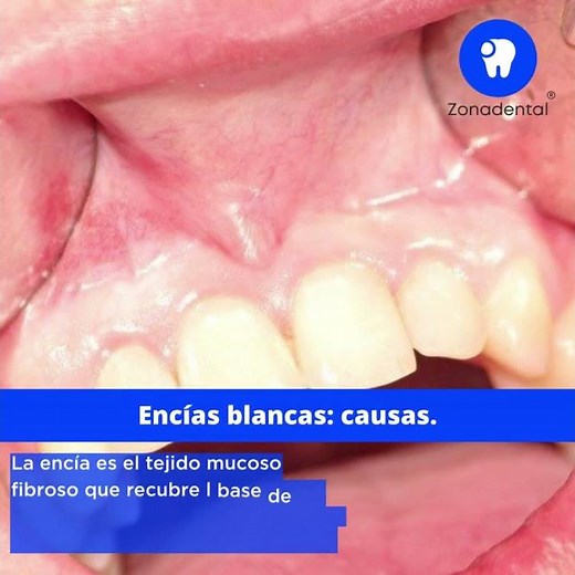 Encías blancas: causas