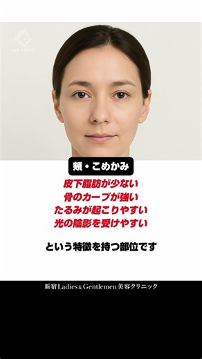【こめかみ・頬のクレーター】#ニキビ跡 #クレーター #サブシジョン #マイクロサブシジョン #今井式ニキビ跡治療#新宿lgクリニック