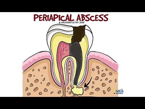 Periapical Abscess