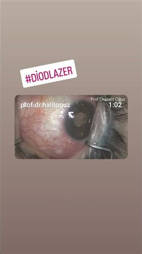 Glokom; Diode Lazer Transskleral Siklofotokoagülasyon Uygulaması