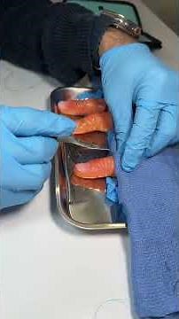 Performing a surgery on a 3D Printed Prosthetic Finger