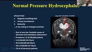 Normal Pressure Hydrocephalus