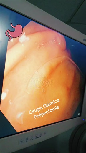 Polipectomía: Prevención del Cáncer Gástrico