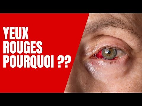 Red Eyes: Causes and Solutions