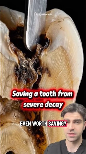 Is This Tooth Even Worth Saving? Dentist Explains (Root Canal or Pull?)