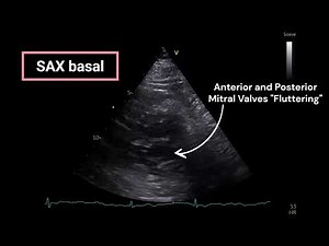 Atrial Flutter (Echocardiography)