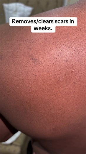 Effective Scar Treatment Options for Clear Skin