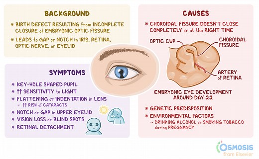 Coloboma: What Is It, Signs and Symptoms, Diagnosis, and More | Osmosis