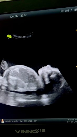 BPD 26 HC 26 (AC 31) FL 27 weeks with large amniotic fluid please comment #reelsfbシ #viralreelsfacebook #baby #facebookreel #follower #hospital #babymoments Bablu Kumar Nishad Facebook Chandeshwar Kumar | Bablu Kumar Nishad