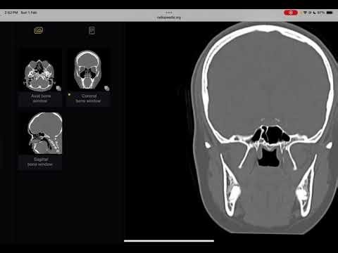 Normal pns imaging