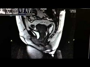 Defecography Or Proctogram For Constipation • Video • MEDtube.net