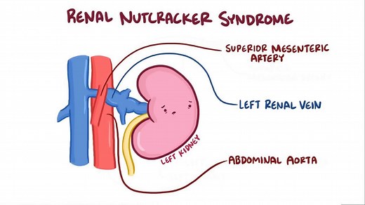 Video: Nutcracker syndrome - Video Explanation! | Osmosis | Osmosis